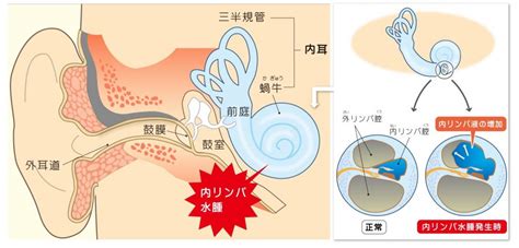 右耳 耳鳴|耳鳴りとは？急ぎ受診が必要な耳鳴りの見分け方や治。